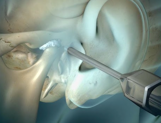 Everything You Need to Know: Arthroscopy and Arthrocentesis Surgeries for TMD